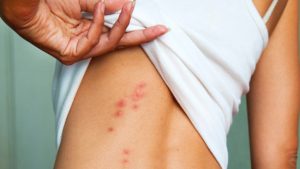 Bed Bug removal