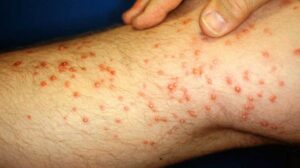 ant bite