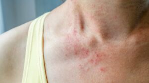 mite bites